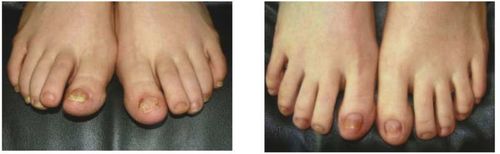Customer photo review of German ToenailPlus™ Anti Paronychia Relief Oil