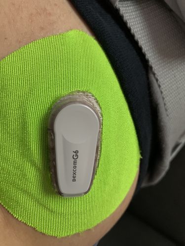 Customer photo review of Dexcom G6 Adhesive Patches - Mystery Pack