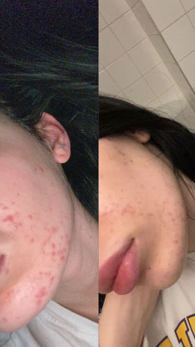 Customer photo review of Salicylsäure BHA 2% 50 ml