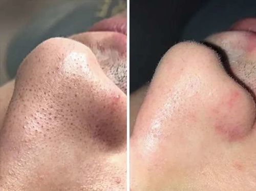 Customer photo review of TOUCHBeauty Ultrasonic BlackheadRemover PoreVacuum（Limited time discount 🔥 last day）