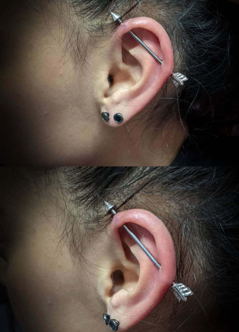 Customer photo review of Piercing Aftercare Keloid Crasher Kit