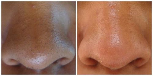Customer photo review of TOUCHBeauty Ultrasonic BlackheadRemover PoreVacuum（Limited time discount 🔥 last day）