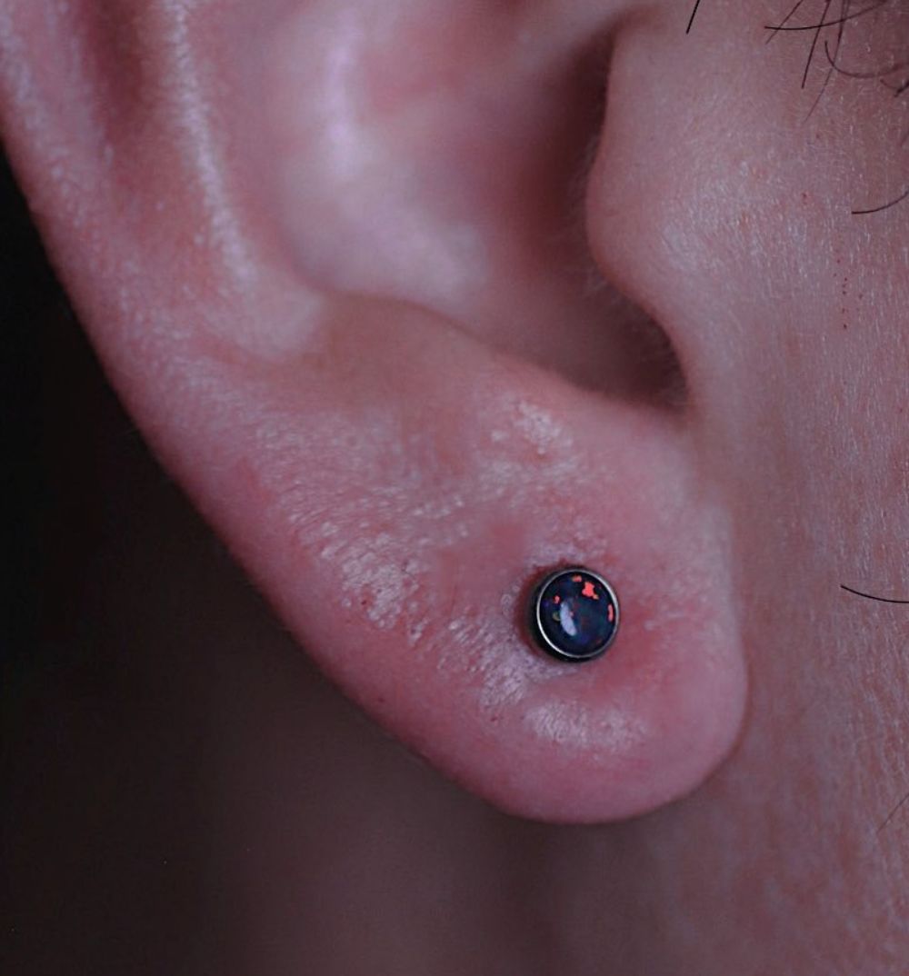 Customer photo review of Piercing Bump Treatment - Bump, Keloid & Scar Relief Oil