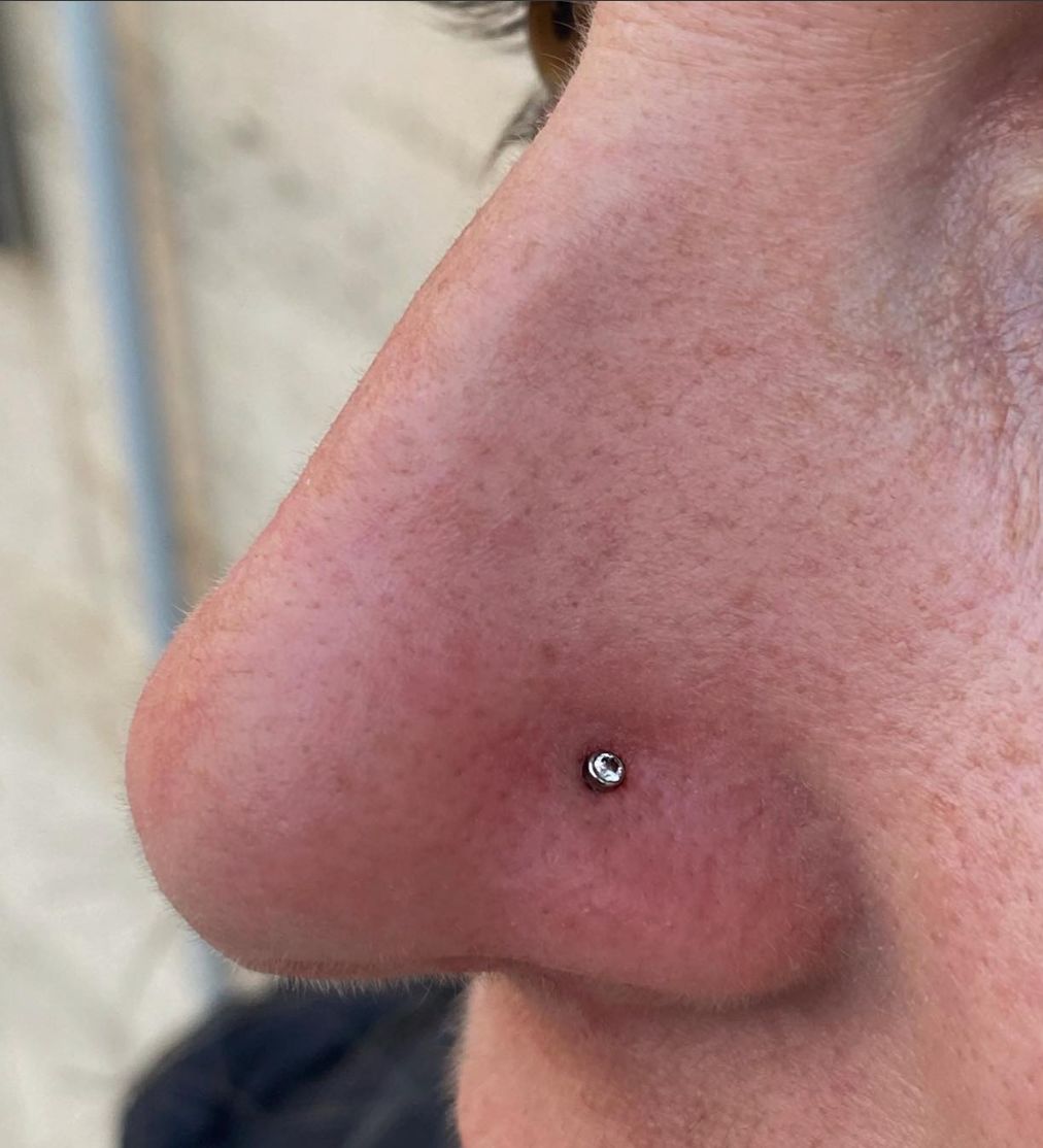 Customer photo review of Piercing Bump Treatment - Bump, Keloid & Scar Relief Oil