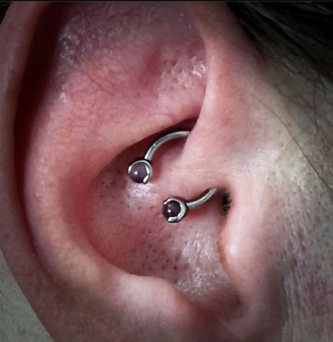 Customer photo review of Piercing Aftercare Keloid Crasher Kit