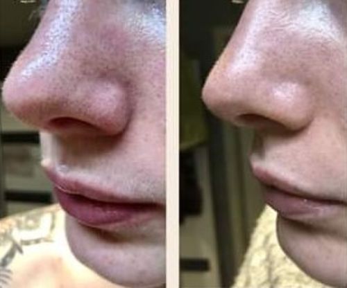 Customer photo review of TOUCHBeauty Ultrasonic BlackheadRemover PoreVacuum（Limited time discount 🔥 last day）