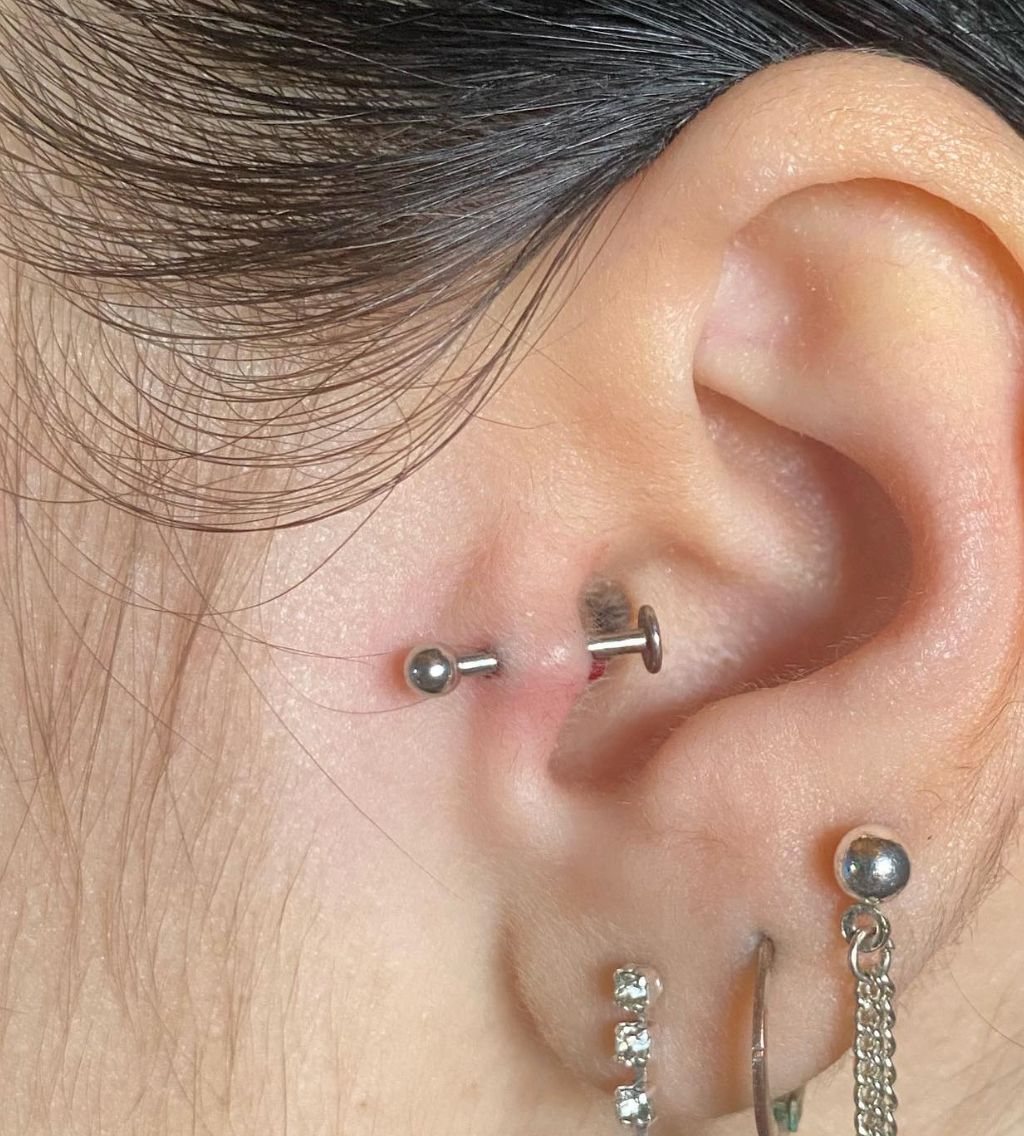 Customer photo review of Piercing Aftercare Keloid Crasher Kit