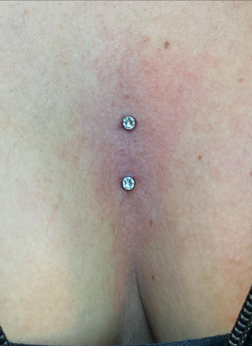 Customer photo review of Piercing Bump Treatment - Bump, Keloid & Scar Relief Oil