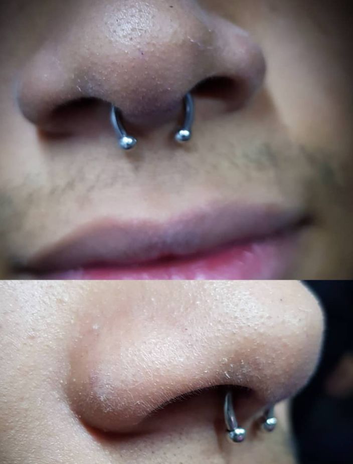 Customer photo review of Piercing Aftercare Keloid Crasher Kit