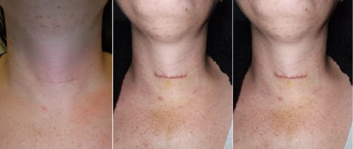 Customer photo review of Bioskin™ Advanced Scar Removal Gel
