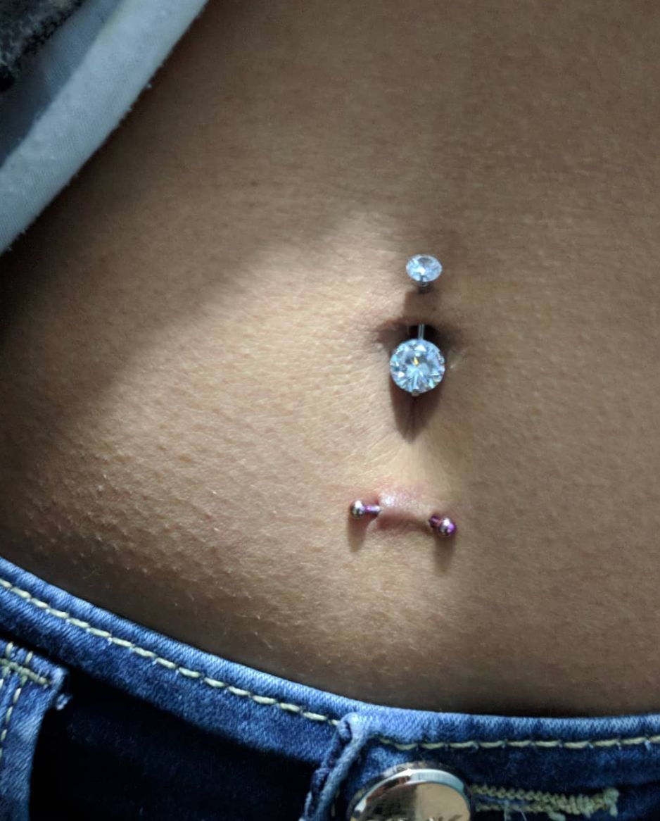 Customer photo review of Piercing Bump Treatment - Bump, Keloid & Scar Relief Oil