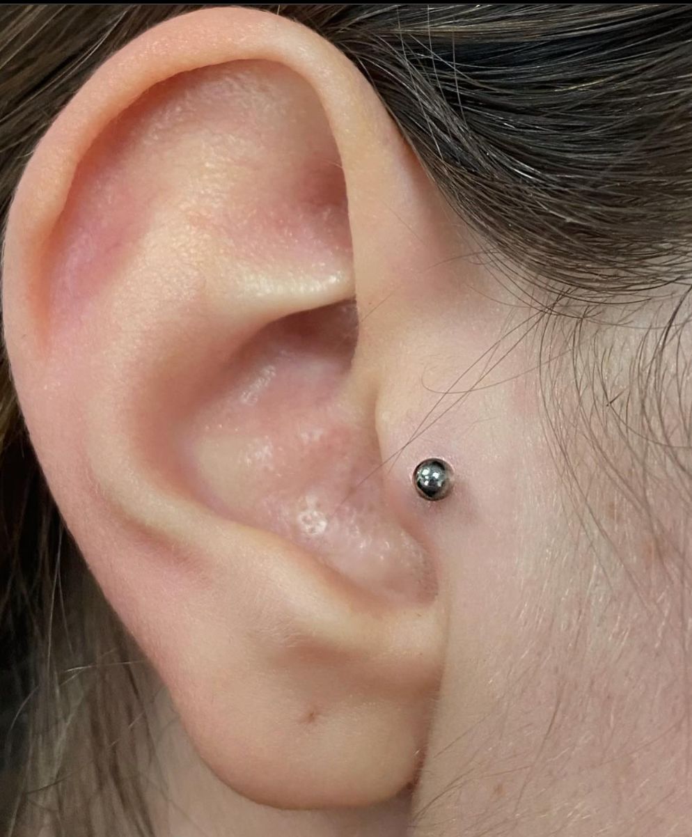 Customer photo review of Piercing Bump Treatment - Bump, Keloid & Scar Relief Oil