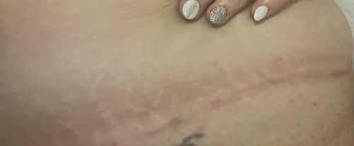 Customer photo review of Bioskin™ Advanced Scar Removal Gel
