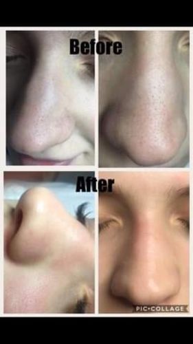 Customer photo review of TOUCHBeauty Ultrasonic BlackheadRemover PoreVacuum（Limited time discount 🔥 last day）