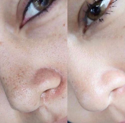 Customer photo review of TOUCHBeauty Ultrasonic BlackheadRemover PoreVacuum（Limited time discount 🔥 last day）