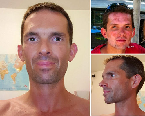 Customer photo review of VitiligoKräm™ Det Mest Naturliga Sättet Att Behandla Vitiligo