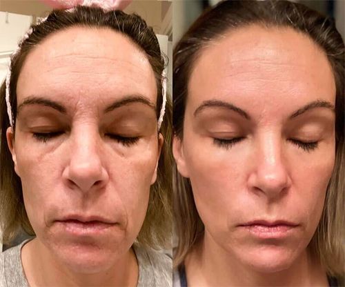 Customer photo review of InstaLyft™ Ansiktslyftande Skönhetsmassage
