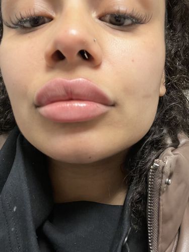 Customer photo review of LipFix: Filler