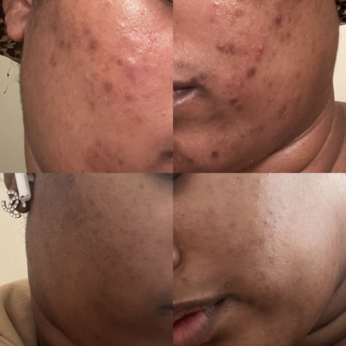 Customer photo review of Bolden Clear Skin Travel Kit