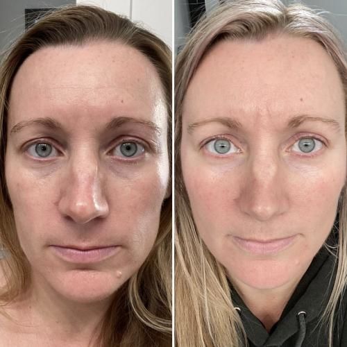 Customer photo review of SkönhetsMask™ Anti-Åldrande EMS Skönhet Massager