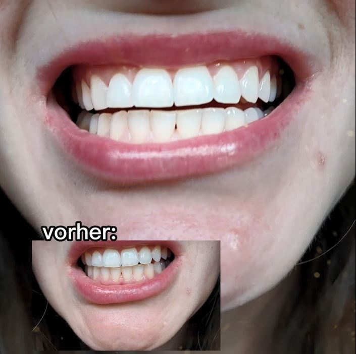 Customer photo review of Zahnbleaching Farbkorrektur Serum