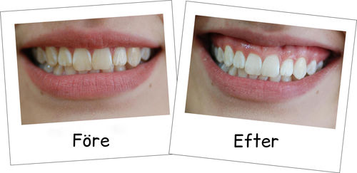 Customer photo review of GumProtect™ Gingival Skydd Tandblekningsgel