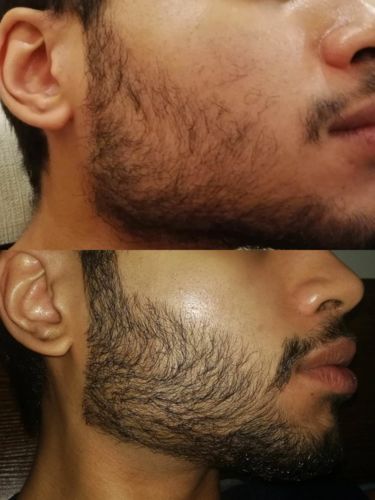 Customer photo review of Beard Growth Oil (1-Year Supply)