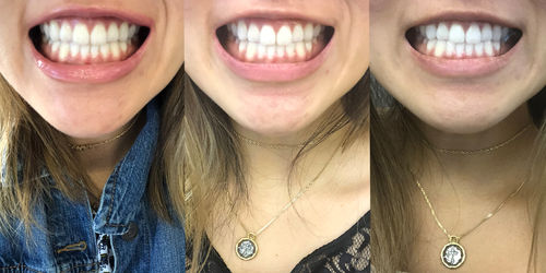 Customer photo review of GumProtect™ Gingival Skydd Tandblekningsgel