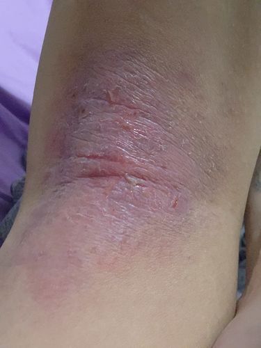 Customer photo review of Eczema Scratch Mitten