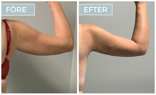 Customer photo review of Beautology™ Arm Bantning Patch