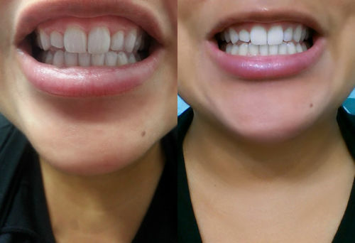 Customer photo review of GumProtect™ Gingival Skydd Tandblekningsgel