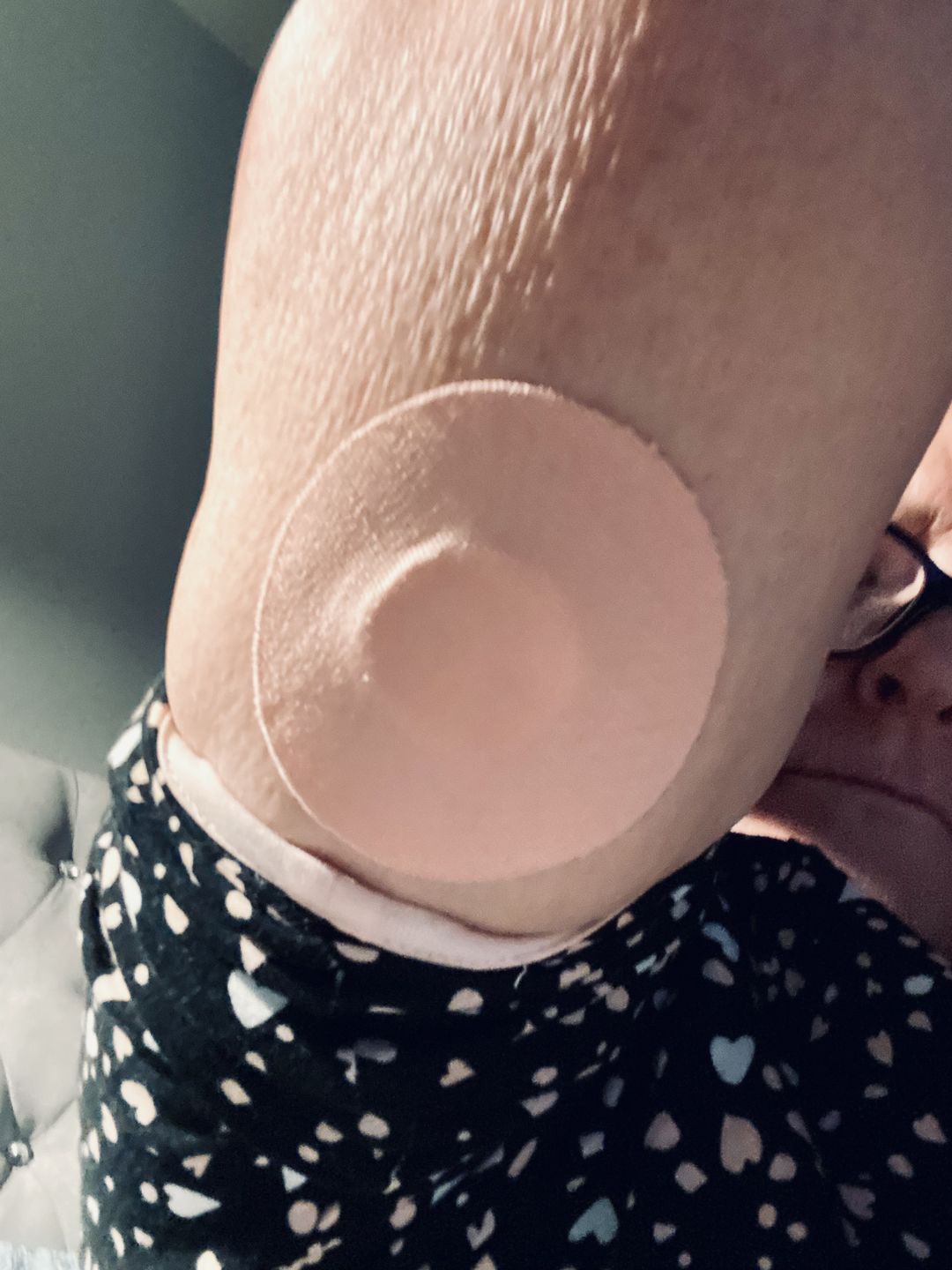 Customer photo review of Skin Grip Original - Freestyle Libre 3 Adhesive Patches