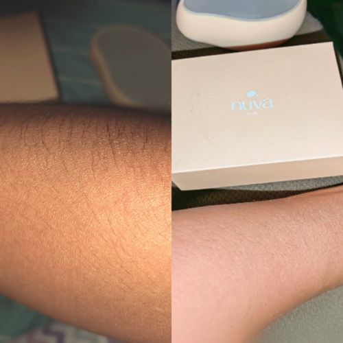 Customer photo review of Depilador Nuva Skin®
