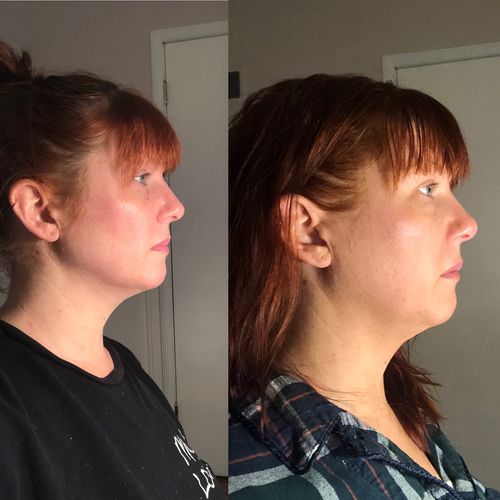 Customer photo review of Beautology™ 5D Skulpterande Ansiktsmask