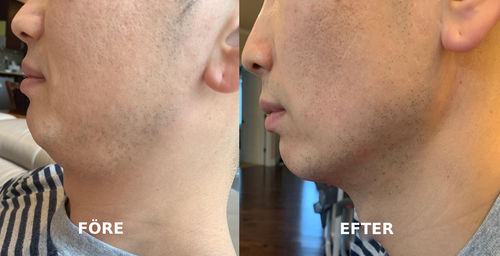 Customer photo review of Beautology™ V-Lyftande Ansiktsskönhetsmask