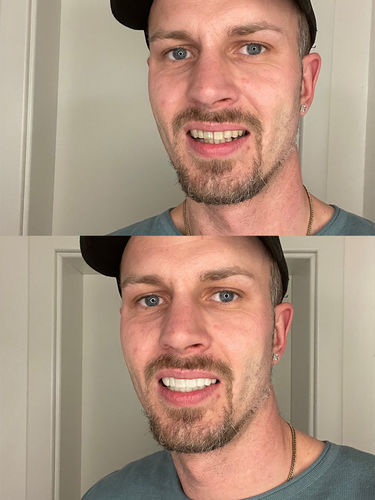 Customer photo review of Teeth-Veneer 2.0