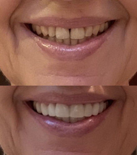 Customer photo review of Teeth-Veneer 2.0