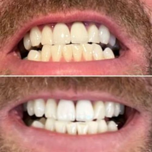Customer photo review of Teeth Whitening Strips