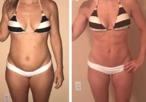Customer photo review of MYMI CurveBelly Wonder Patch（🔥Limited time discount）
