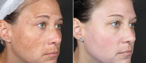 Customer photo review of GloWhite™ Dark-Spot Corrector Cream（🔥Limited time discount）