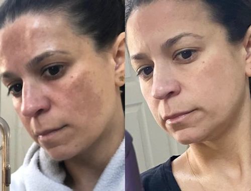 Customer photo review of GloWhite™ Dark-Spot Corrector Cream（🔥Limited time discount）