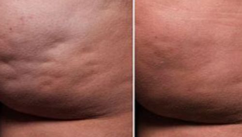 Customer photo review of Oveallgo™ HerbalFirm PURI Cellulite Reduction Patches（🔥Limited time discount）