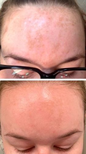 Customer photo review of GloWhite™ Dark-Spot Corrector Cream（🔥Limited time discount）