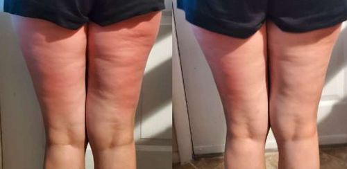 Customer photo review of Oveallgo™ HerbalFirm PURI Cellulite Reduction Patches（🔥Limited time discount）