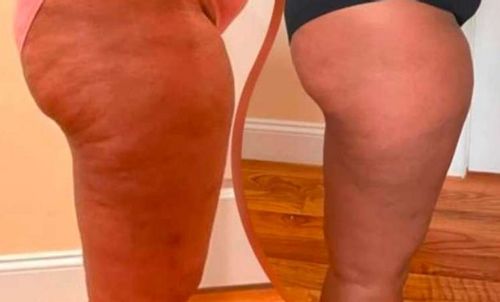 Customer photo review of Oveallgo™ HerbalFirm PURI Cellulite Reduction Patches（🔥Limited time discount）
