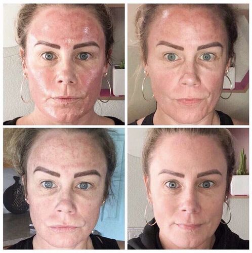 Customer photo review of GloWhite™ Dark-Spot Corrector Cream（🔥Limited time discount）