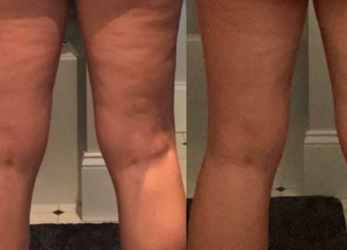 Customer photo review of Oveallgo™ HerbalFirm PURI Cellulite Reduction Patches（🔥Limited time discount）