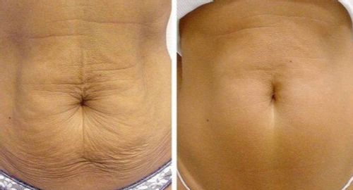 Customer photo review of MYMI CurveBelly Wonder Patch（🔥Limited time discount）