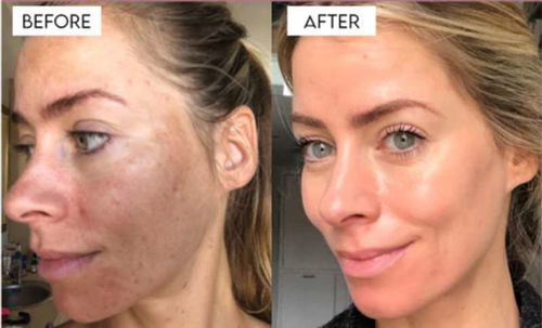 Customer photo review of GloWhite™ Dark-Spot Corrector Cream（🔥Limited time discount）