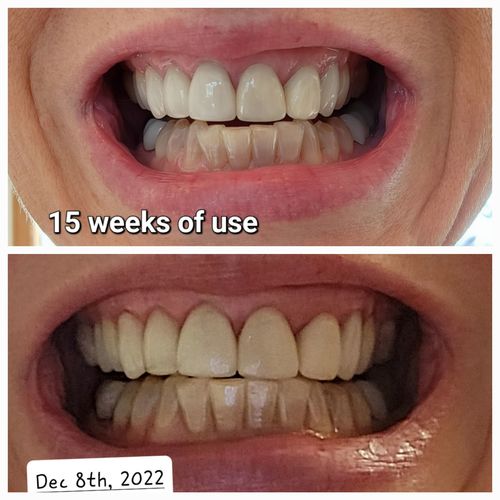Customer photo review of bedrō Whitening